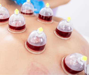 Wet Cupping