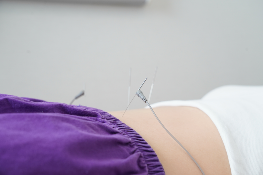 traditionalmedicine, acupuncture,  